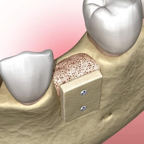 Bone Grafting