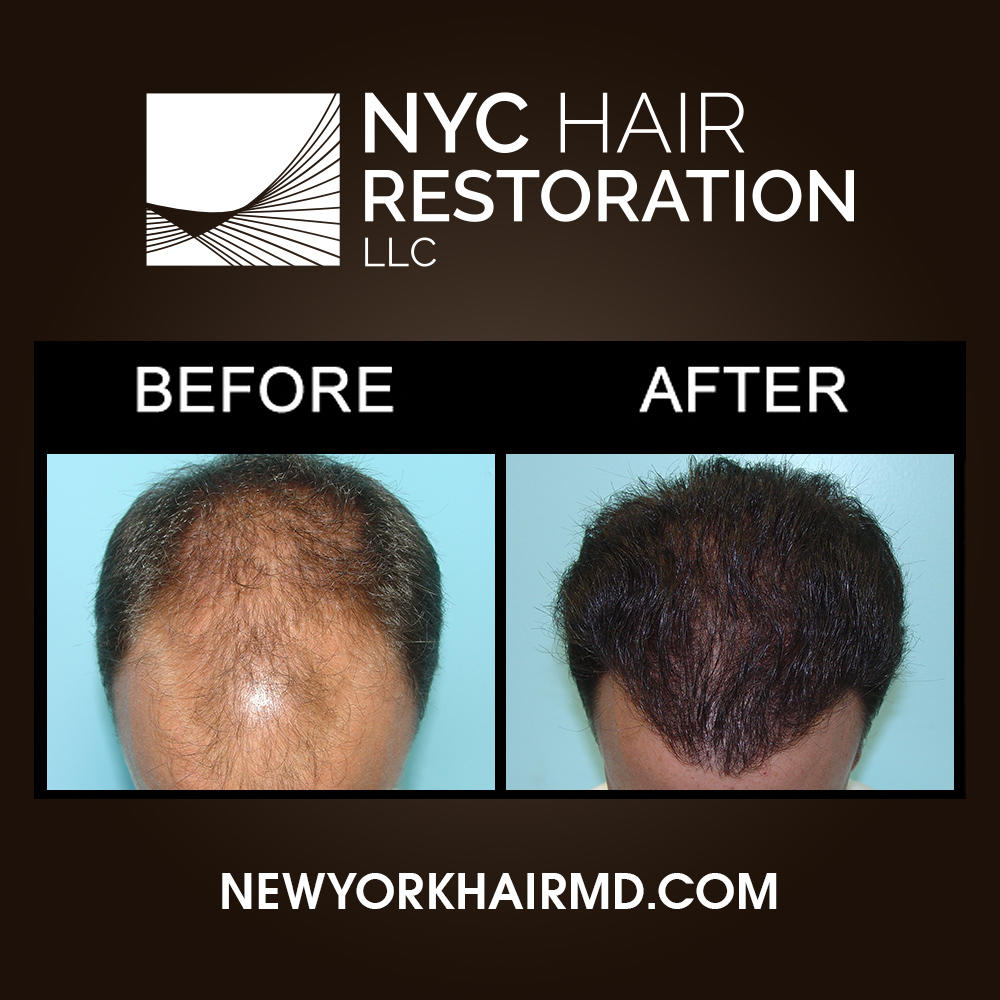 NYC Hair Restoration Photo