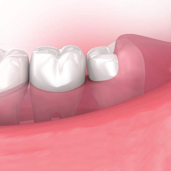 Wisdom Teeth Removal