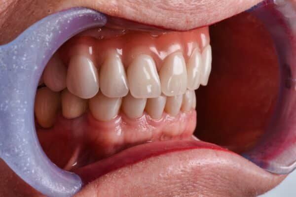 Dentures