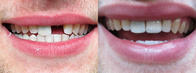Cosmetic dental repair. Cosmetic dental repair.
