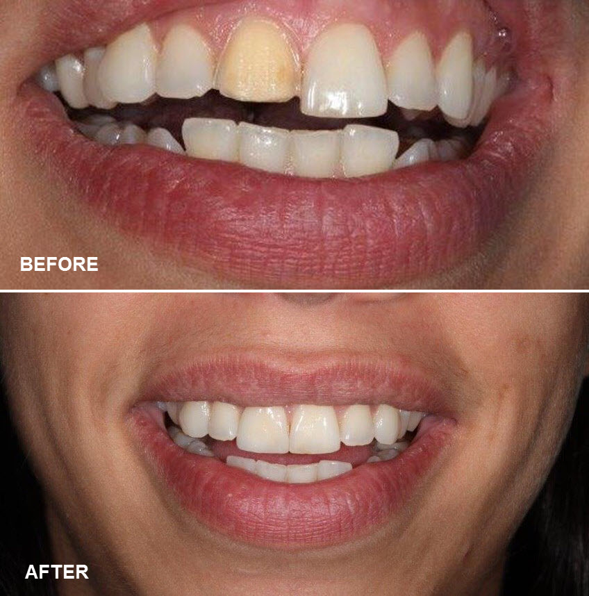 Images Poly-Dent Ceramic
