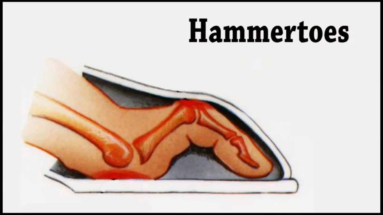 Hammertoe