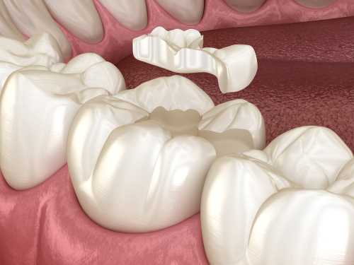 Porcelain Inlays