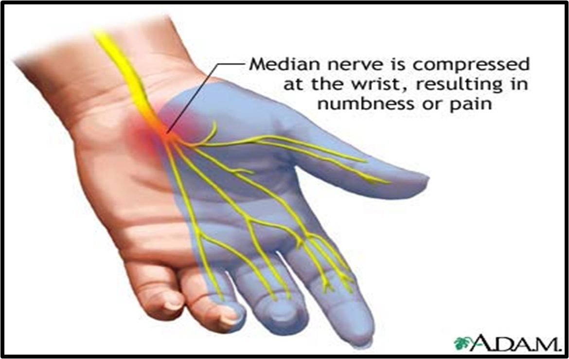 Carpal Tunnel Syndrome usually Causes numbness in the thumb , Index and long fingers.