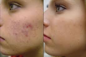 Ipl Photofacial