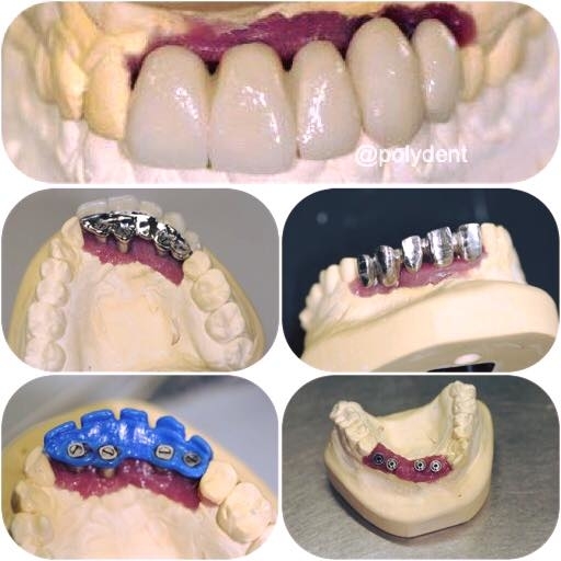 Images Poly-Dent Ceramic