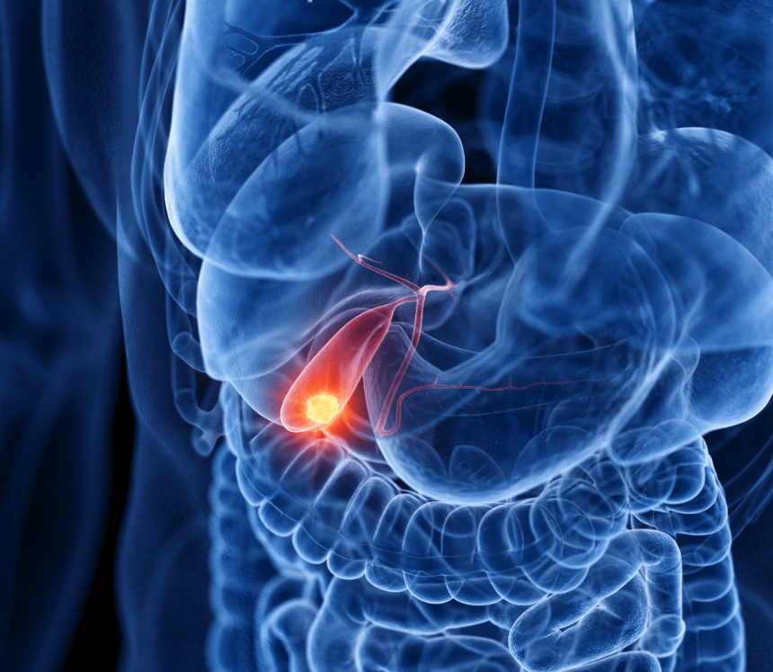 Cholecystectomy