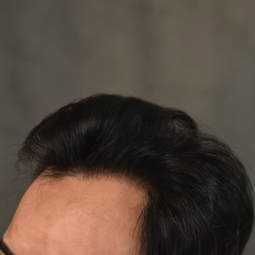 Hair Restoration