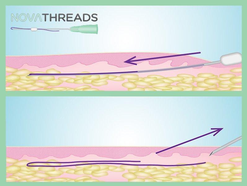 NewEraLift with Dr. Liliana Manrique Image