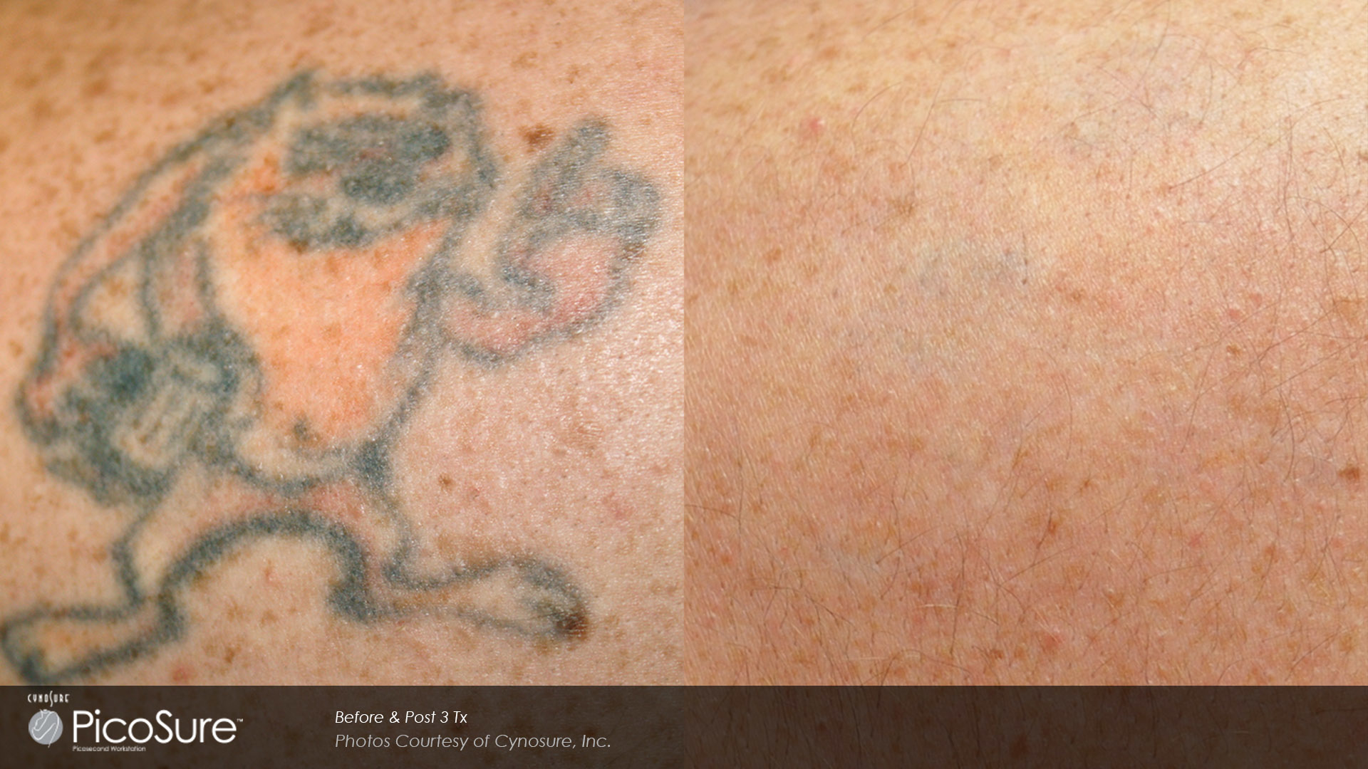 Inklifters Tattoo Removal Photo