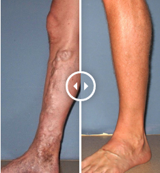 Precision Vein Therapeutics Photo