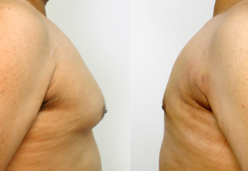 Chicago Liposuction by Lift Body Center Photo
