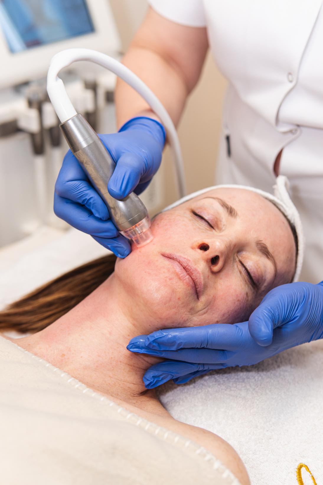 Microneedling Reverse Needling Bern – gentle microneedling with GlowSolution
