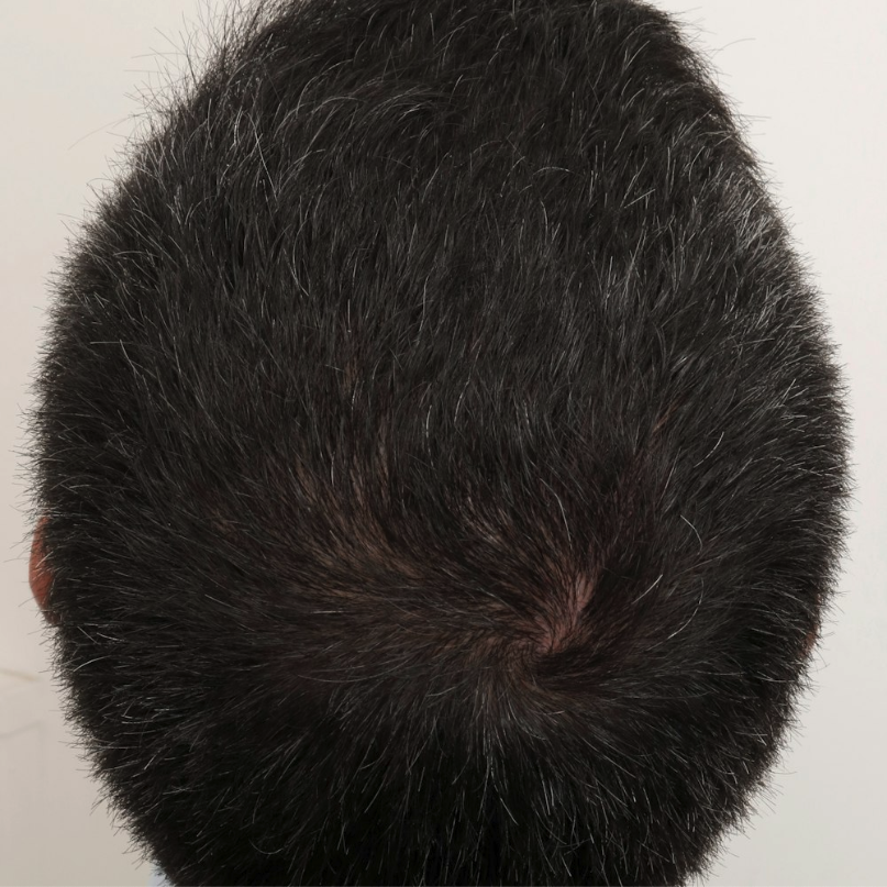 Hair Restoration