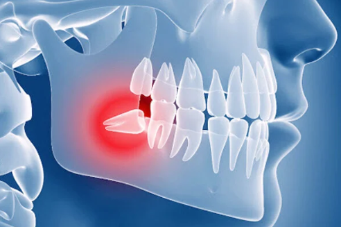Chirurgia orale / estrazioni di denti del giudizio