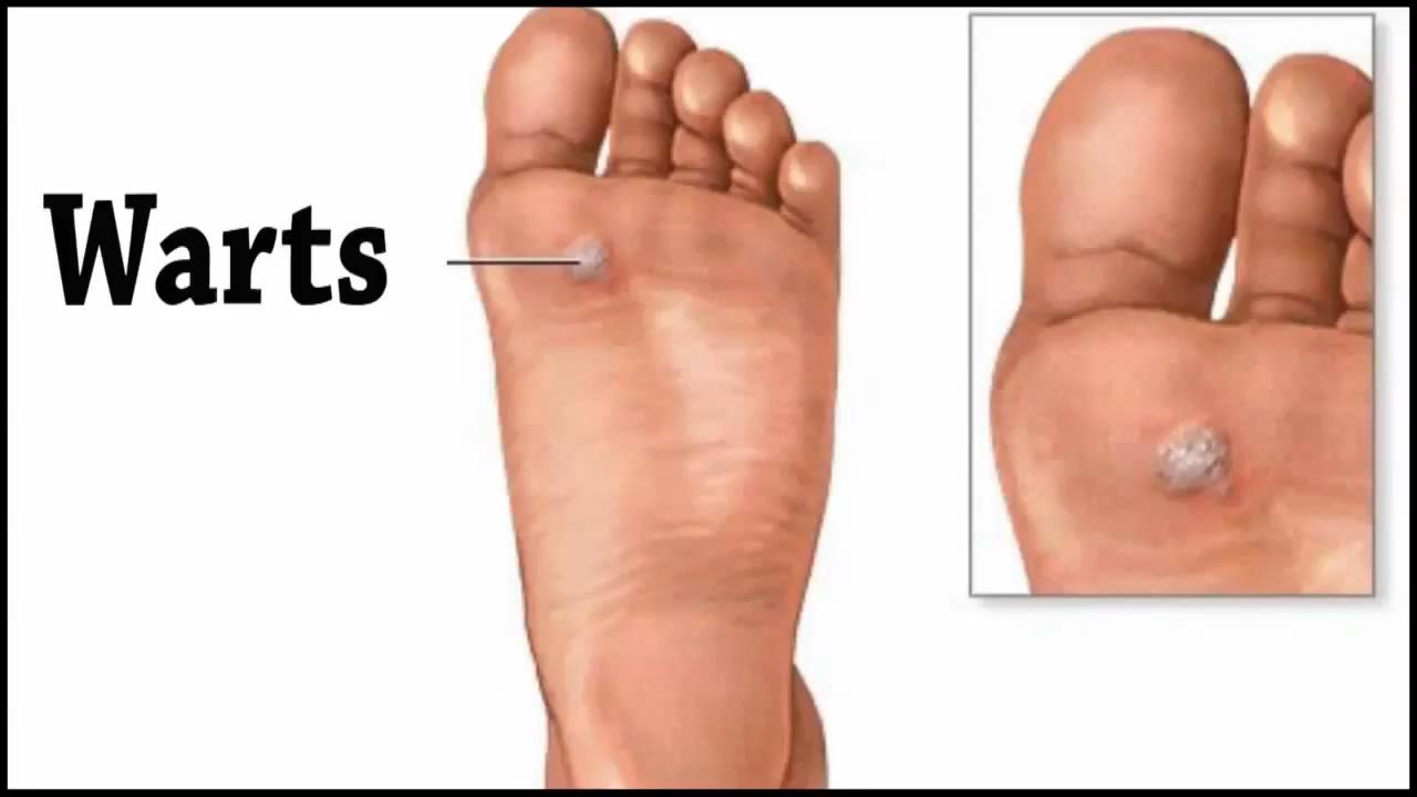 Hammertoe