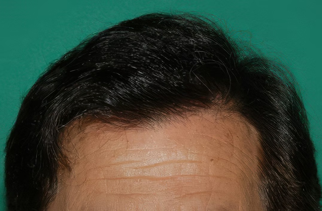 Hair Restoration