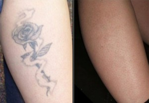 Laser Tattoo Removal 