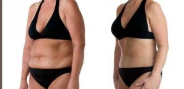 Abdominoplasty