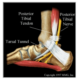 Corticosteroid injection plantar fasciitis
