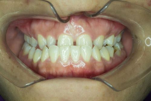 Gum Bleaching
