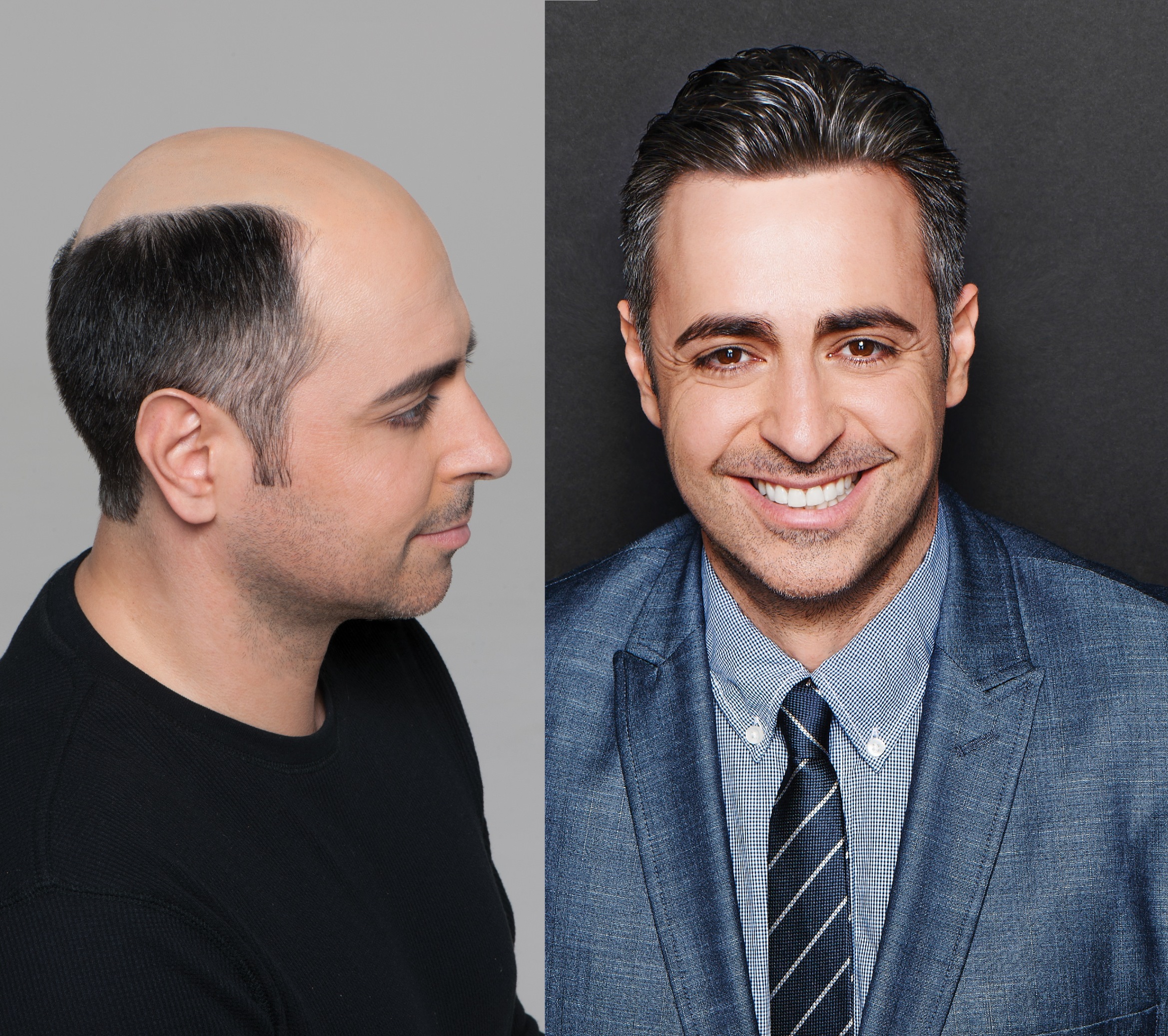 HRC Hair Restoration Of California, 11500 W Olympic Blvd Ste 330, HRC- Hair  Restoration of California was established in 1990. We operate two locations  in Los Angeles County, one in West Los