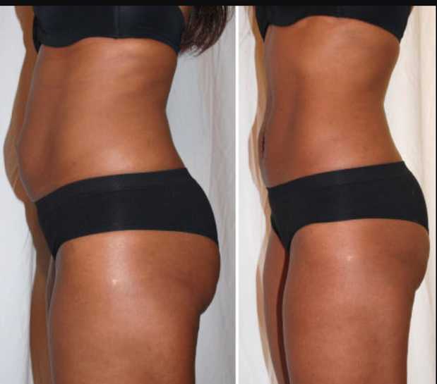 Images Renew Body Contouring