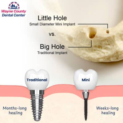 Mini Dental Implants