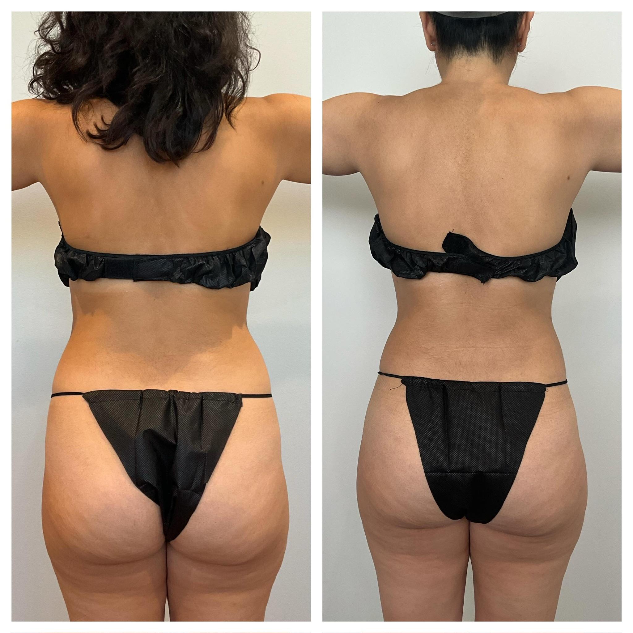 BodyLuxe | FormSculpt Awake Liposuction & Fat Transfer by Daniel J Farrugia MD PhD FACS Image