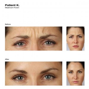Botox/Dysport