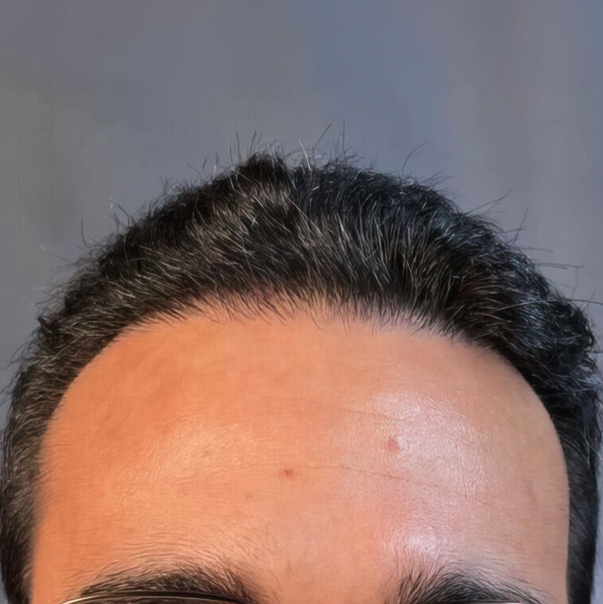 Hair Transplant Revision