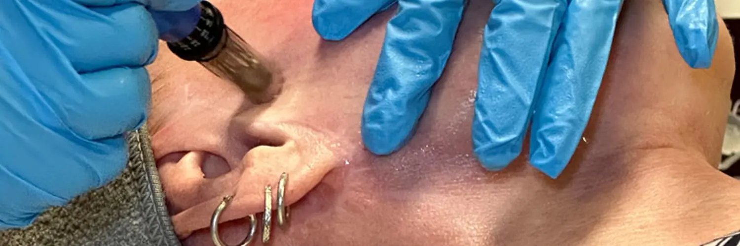 Microneedling