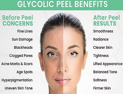 Chemical Acid Peel