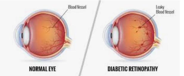 Diabeties Eye Exam