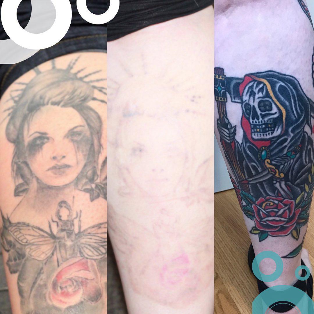 Removery Tattoo Removal & Fading à Ottawa: Before & After Shin Tattoo Removal