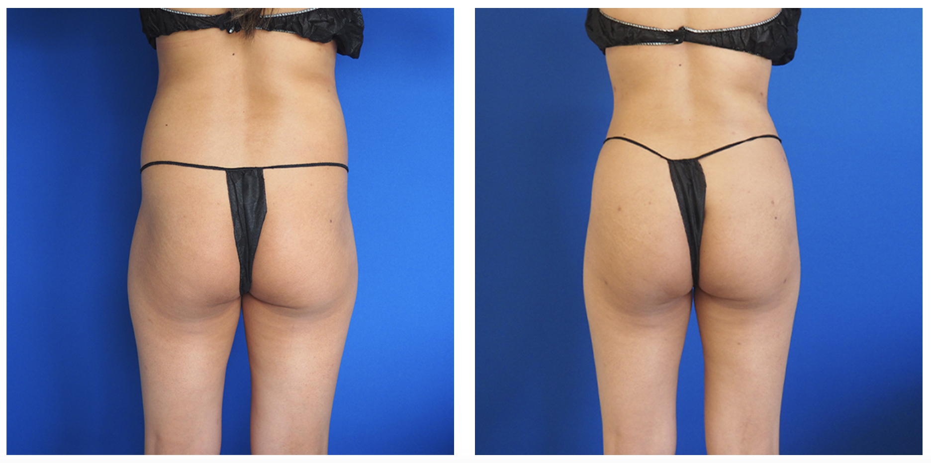 This patient had liposuction of the abdomen, flanks, and back in addition to hip re-shaping with natural fat transfer.