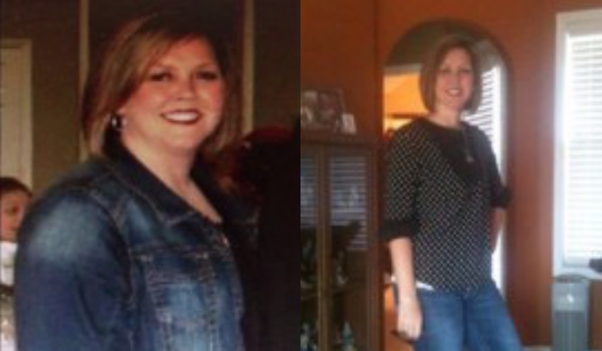 Before and After - Gastric Sleeve