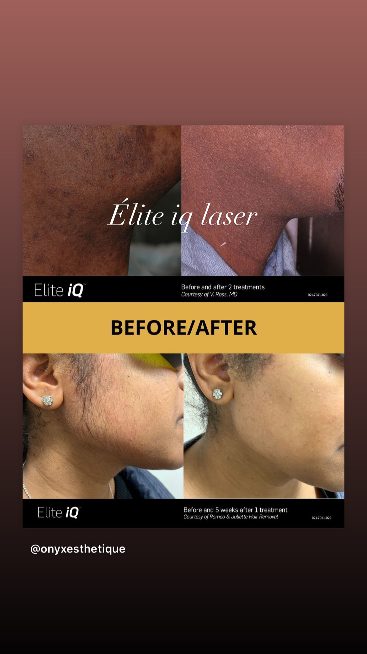 Images Onyx Esthétique - Soins esthétiques, Soins de la peau, Laser Cynosure Gatineau