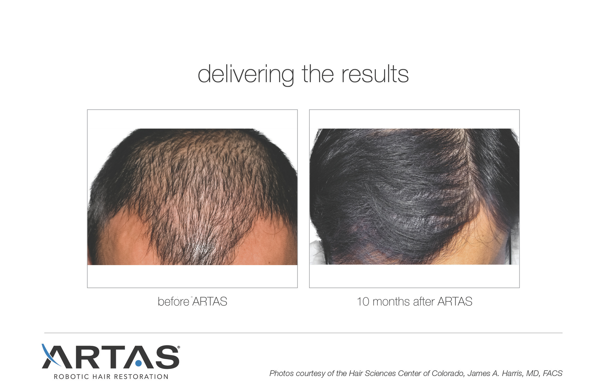 Images Follicl MD - Hair transplant - Greffe de cheveux