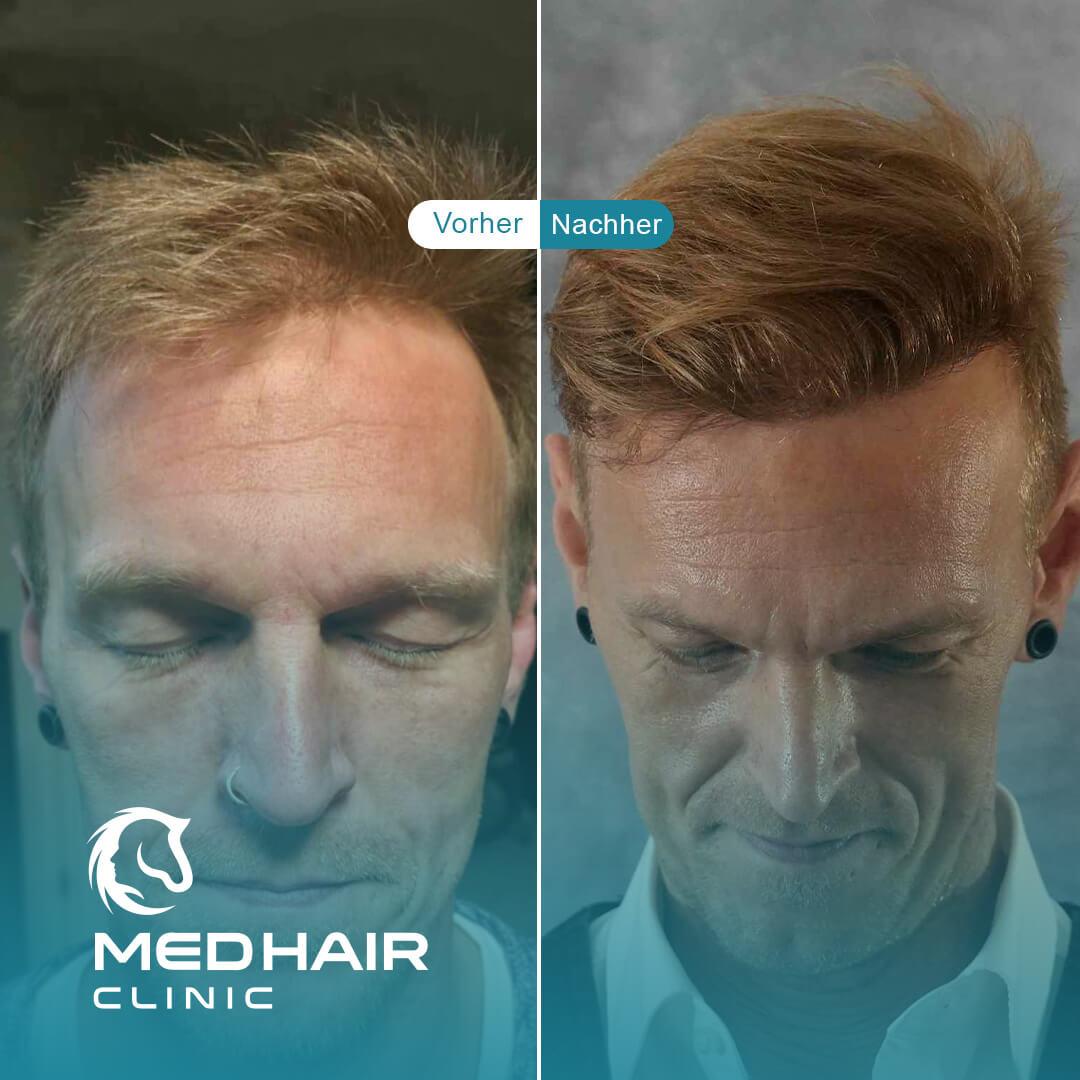 MedHair Clinic | Niederlassung Berlin | Haartransplantation Türkei, Silvio Meier Strasse 2 in Berlin