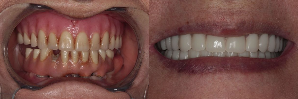 Before & After from Southern Dental Implant Center | Cordova, TN