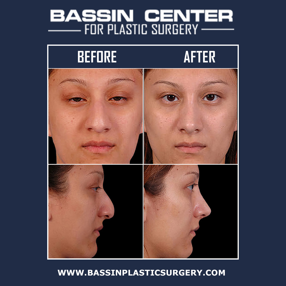 Rhinoplasty surgery in Tampa corrects the proportions of the nose for a more symmetrical appearance. Bassin Center For Plastic Surgery in Tampa offers both "open" and "closed" rhinoplasty procedures to suit the needs of every patient.