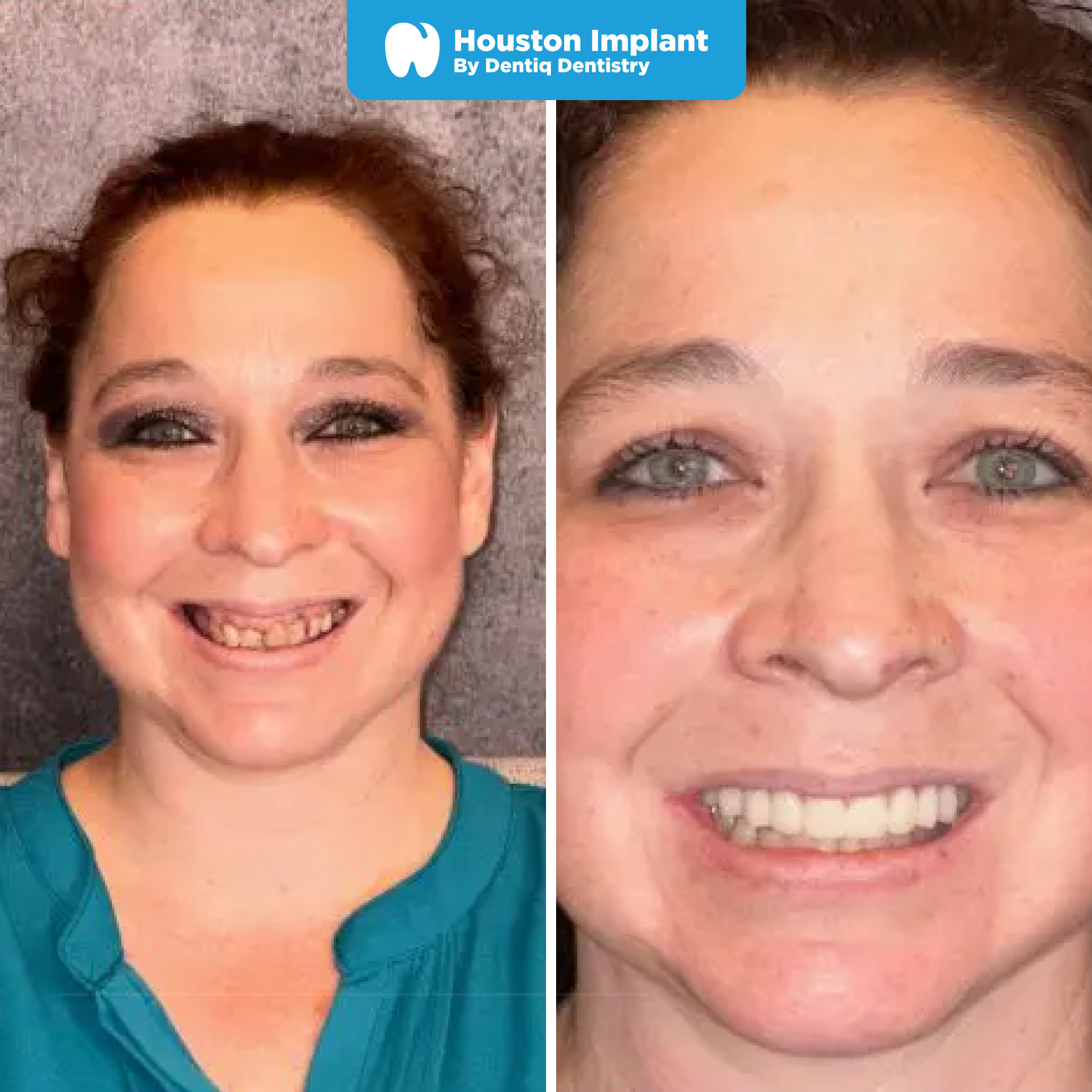 Before and after full mouth reconstruction 
