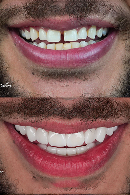 Before and After of Porcelain Veneers