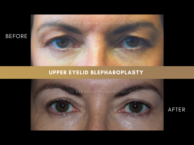 Images Plastic Eye Surgery Associates, PLLC