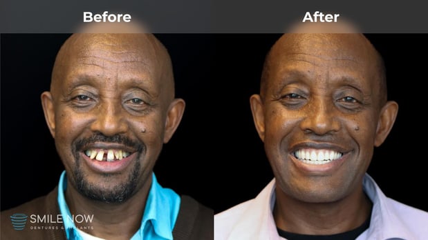 Images Smile Now Milwaukee Dentures and Implants