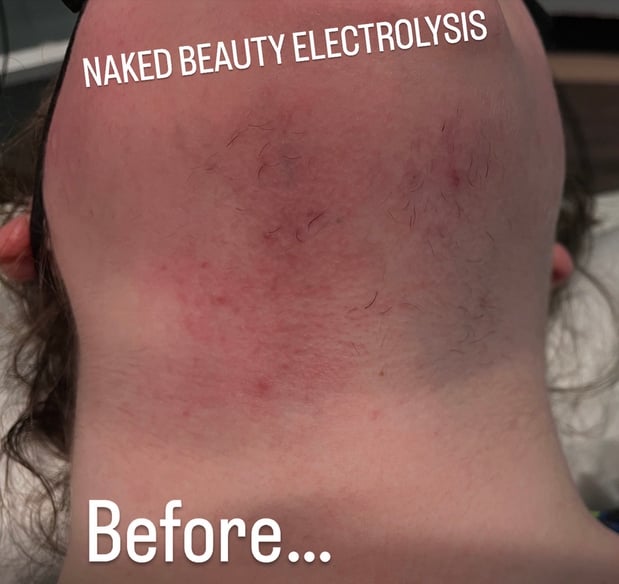 Images Naked Beauty Electrolysis