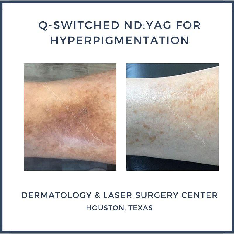 Before and After photo of a patient that recently underwent treatment for Hyperpigmentation.