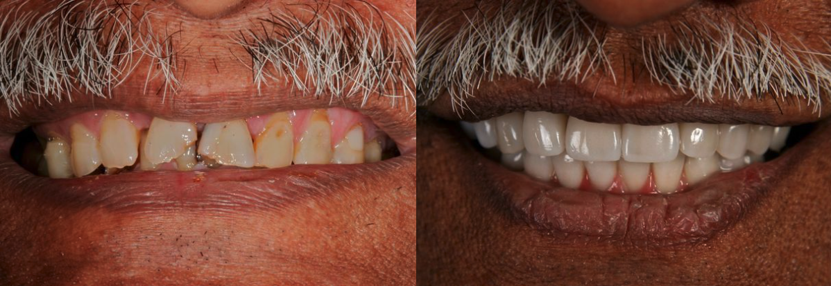 Dental Implants Before & After at Schmitt Prosthodontics | Altamonte Springs, FL